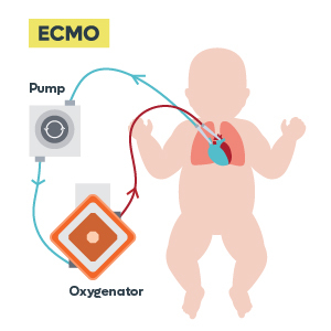 ECMO with baby drawing