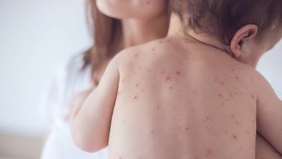 Baby with measles rash