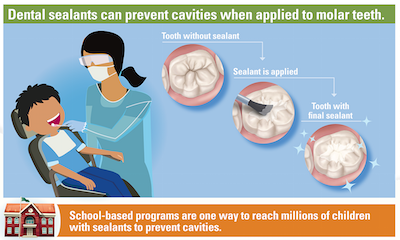 CDC Dental Sealants