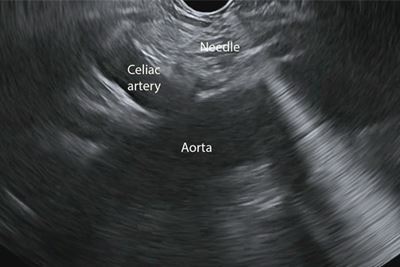 Chronic Pancreatitis