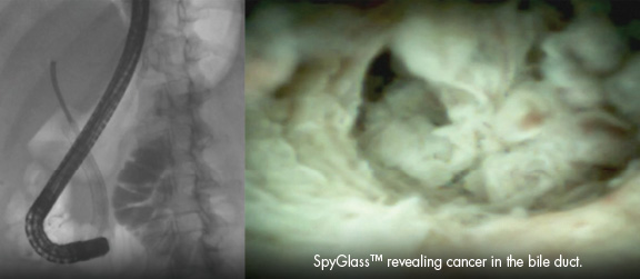 Endoscopic Retrograde Cholangiopancreatography