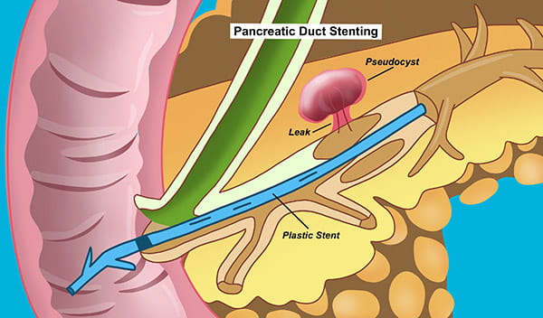 Chronic Pancreatitis