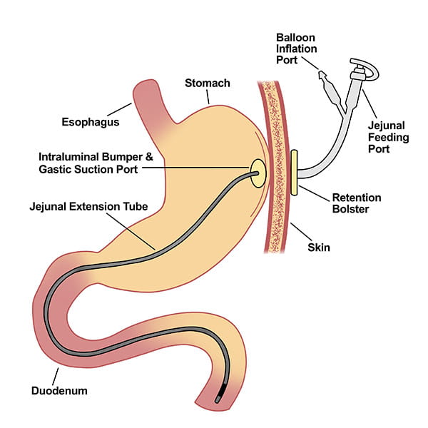 Chronic Pancreatitis