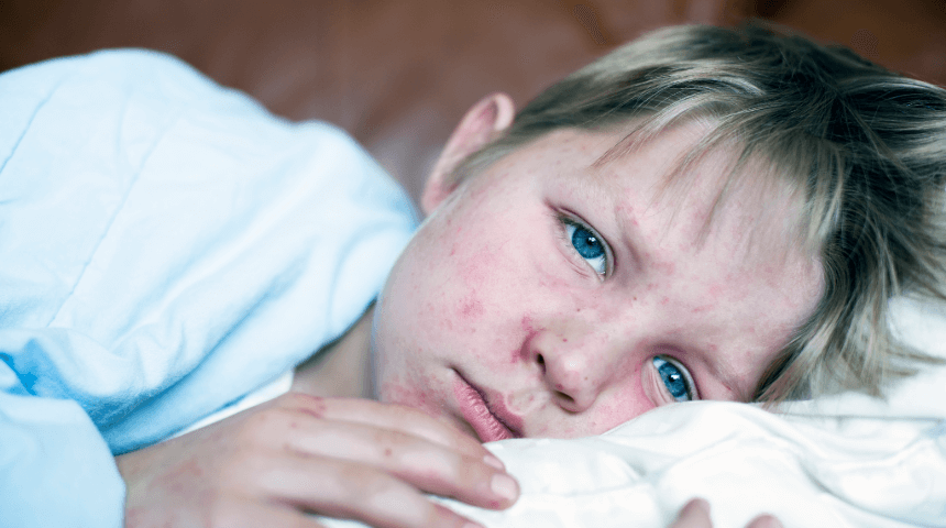 Measles Cases Rising: What Parents Need To Know