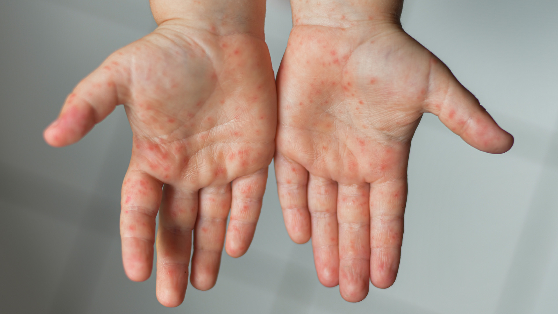 Hand, Foot and Mouth Disease: What Parents Need To Know 