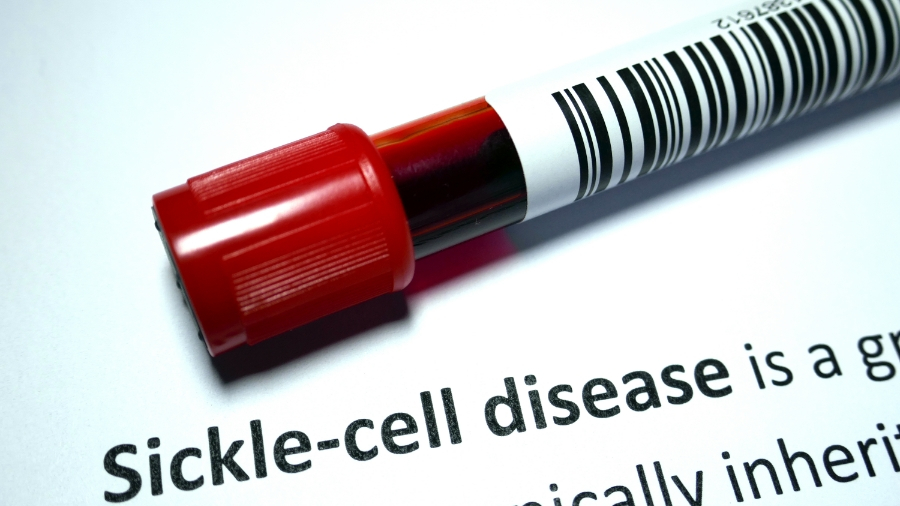 What to Know About Sickle Cell Disease