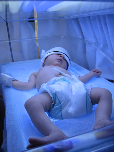 Baby with Jaundice Undergoing Light Therapy in Incubator