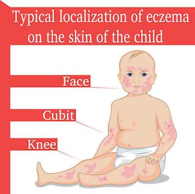 Eczema in Children